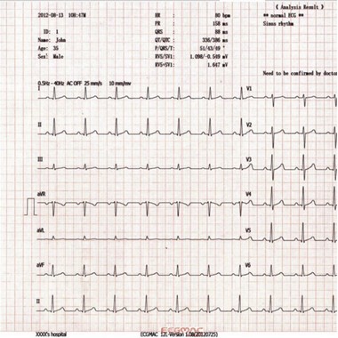 ECG PAPIER 1